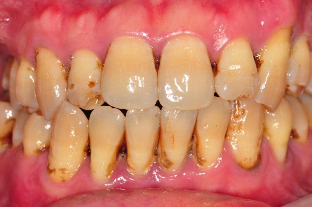 Advanced Training Workshop on Furcation & Hopeless Teeth