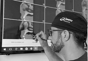 USURA, EROSIONE, ABRASIONE: RAZIONALE CLINICO-SCIENTIFICO PER LA RIABILITAZIONE DI PAZIENTI – Dott. Guido Batalocco