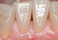 LA GESTIONE DEI TESSUTI MOLLI PARODONTALI E PERI-IMPLANTARI: LA CHIRURGIA PLASTICA PARODONTALE – corso teorico pratico Parodontologia- Dott. Alberto Fonzar