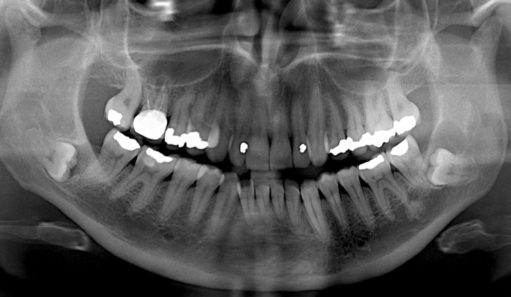 Corso avanzato di perfezionamento in chirurgia orale in due incontri