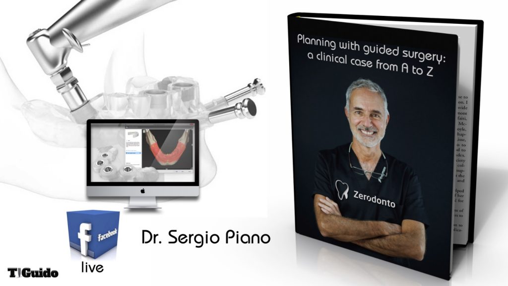 Planning with guided surgery: a clinical case from A to Z