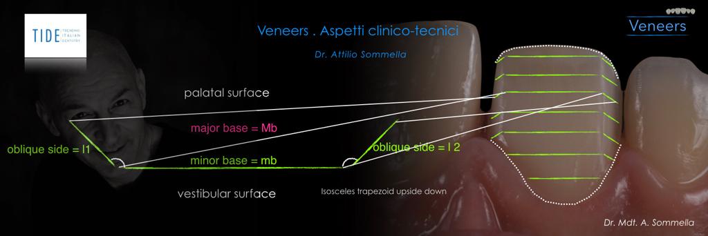 Veneers: concetti avanzati. Aspetti clinico-tecnici