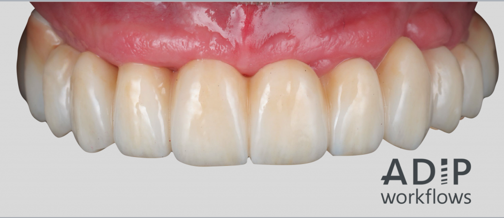 An Update on Digital Implantology and Prosthodontics