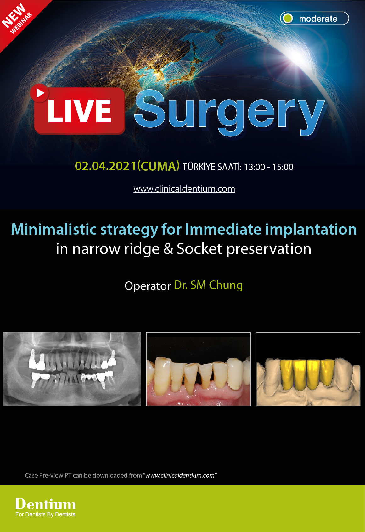 02.04.2021 Dentium Live Surgery – Minimalistic strategy for Immediate implantation in narrow ridge & Socket preservation