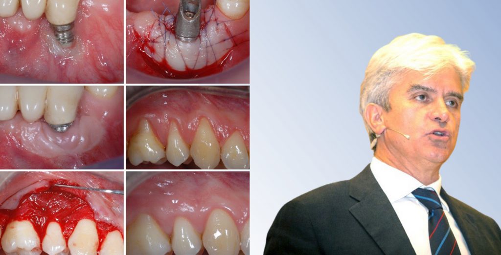 GESTIONE DEI TESSUTI MOLLI IN TERAPIA PARODONTALE E IMPLANTARE