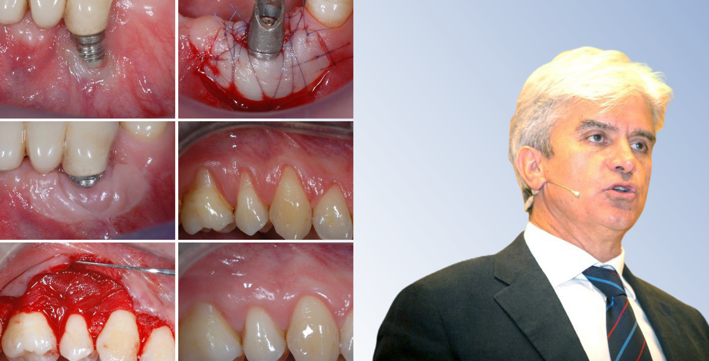 GESTIONE DEI TESSUTI MOLLI IN TERAPIA PARODONTALE E IMPLANTARE