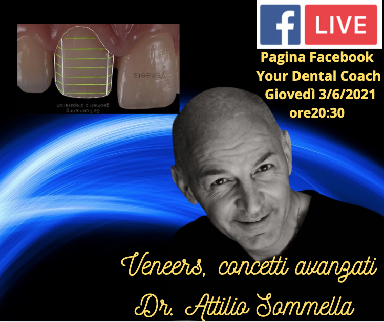 Veneers, concetti avanzati