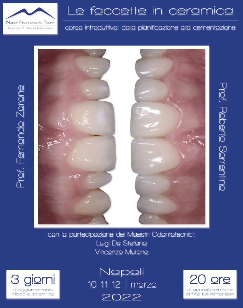 Le faccette in ceramica